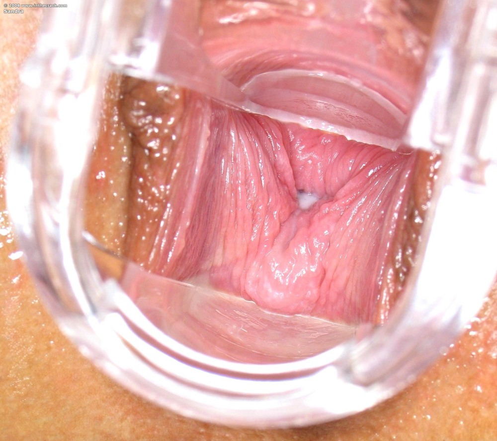 Open vagina uterus