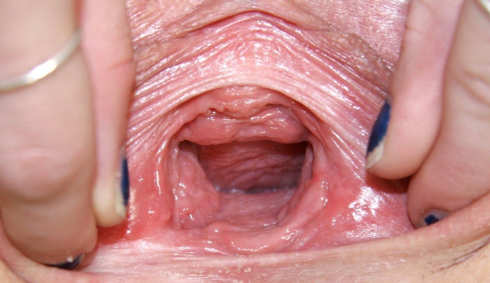 The inner type of vagina
