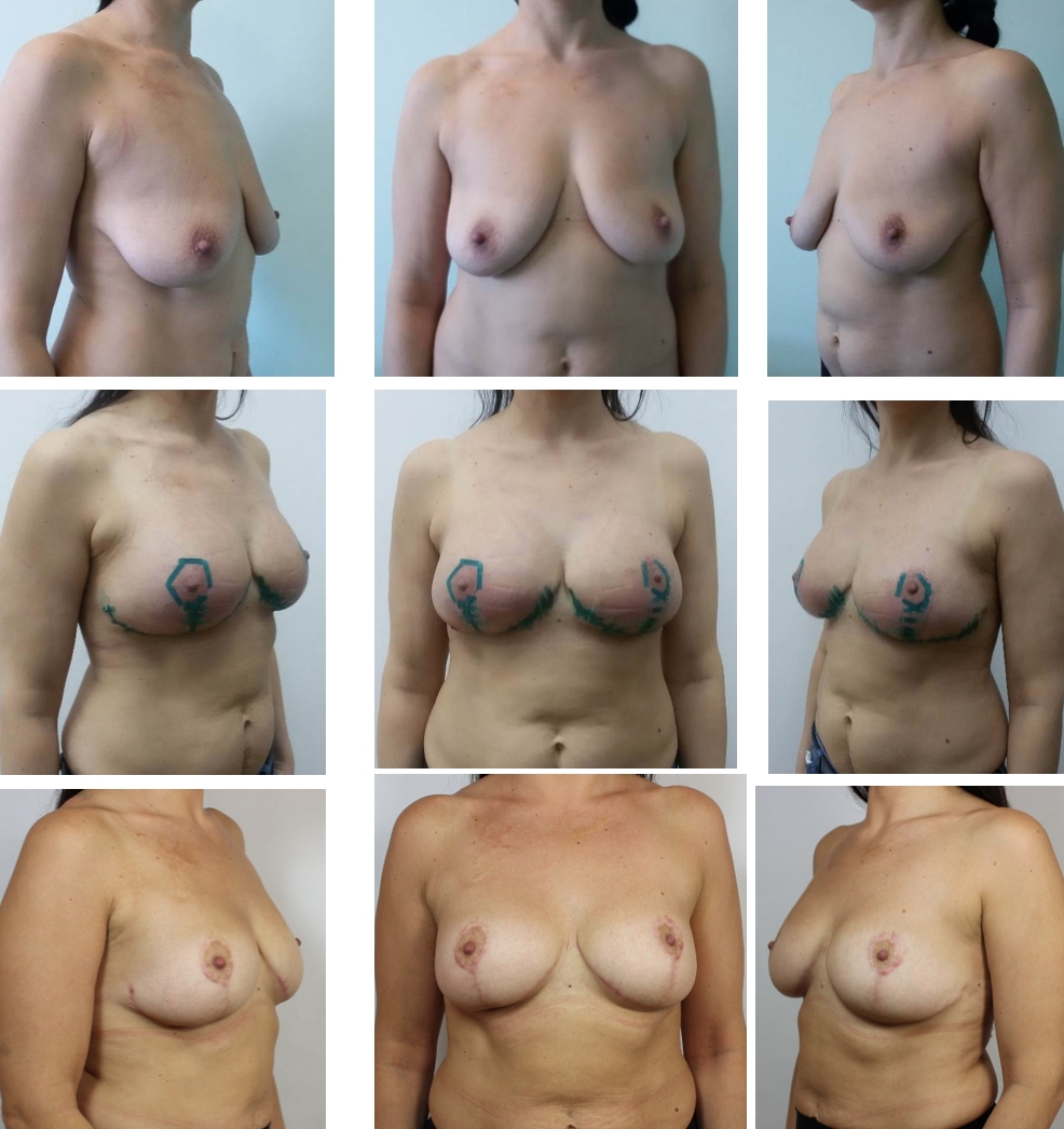 Forms of naked female breast