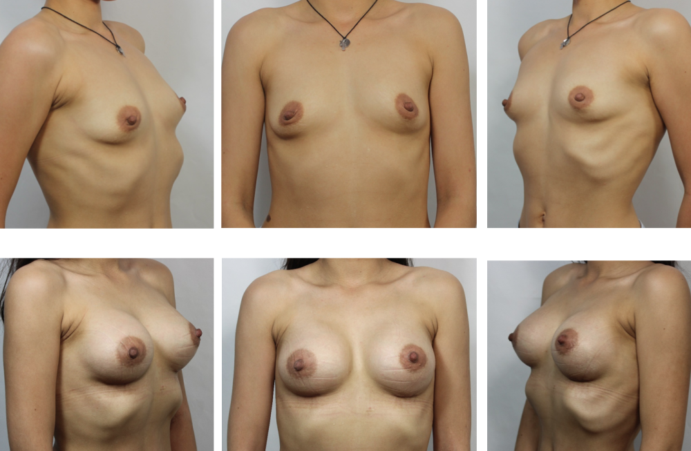 Naked breasts of different shapes