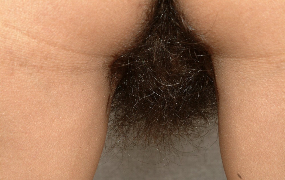 Very hairy pubis in women