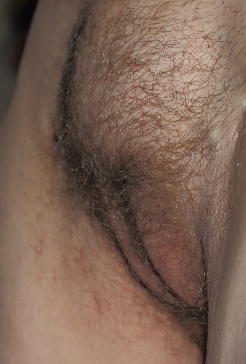 Pubic hair in women