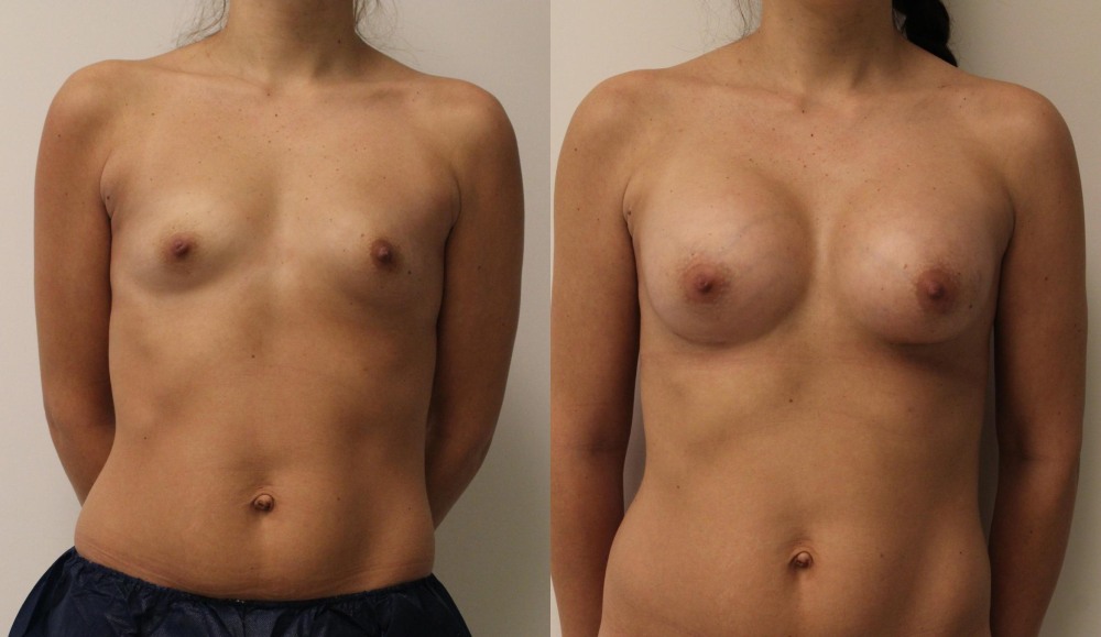 Women's breasts in Anfas Nyud