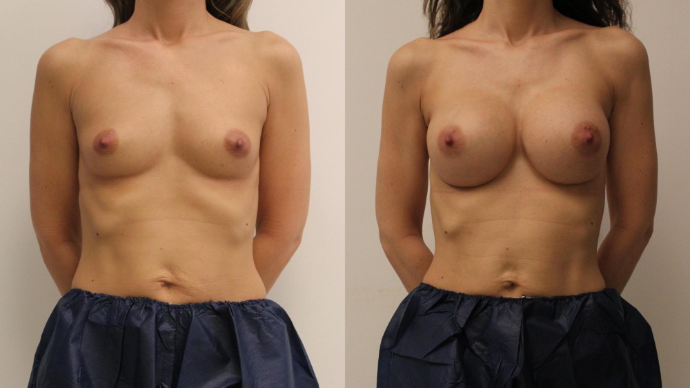Amateur mature little boobs
