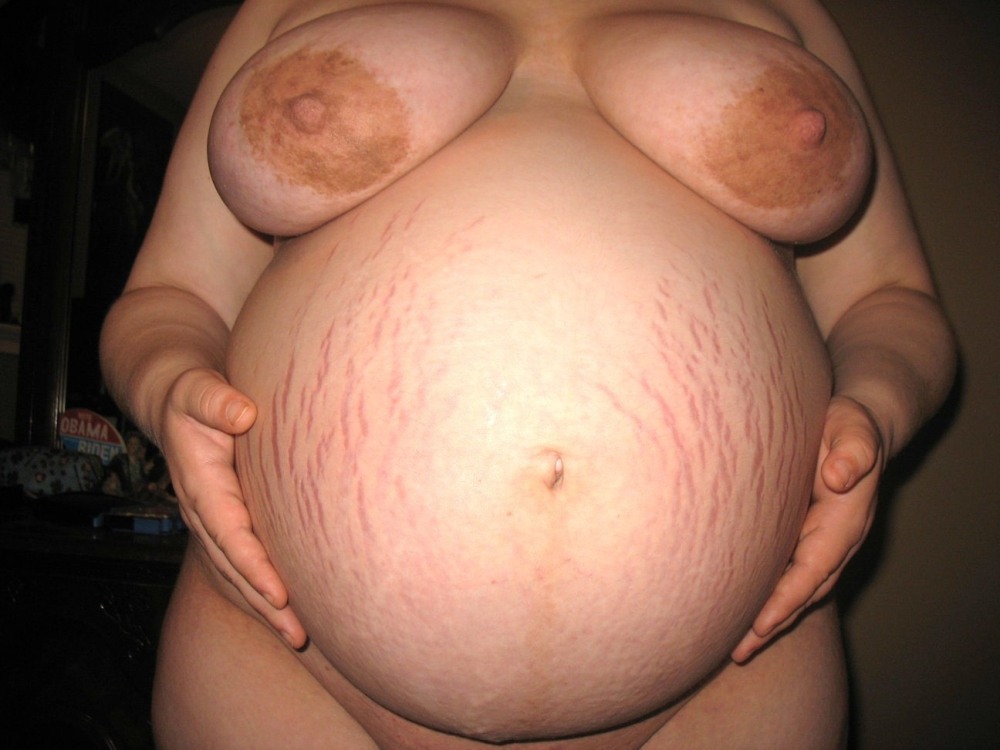 Silicone Free Tits Big Stretching Marks